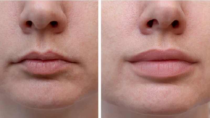 Lip Fillers – Benefits And Application
