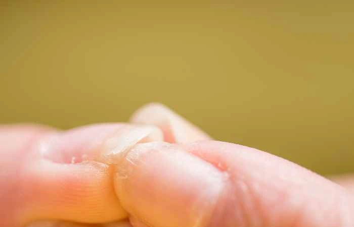 Do Dietary Supplements Help With Dry Fingernails?