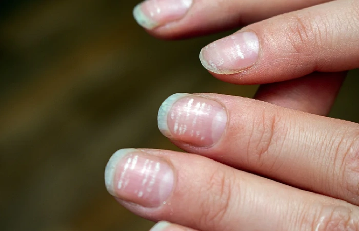 Dry Fingernails Due To Vitamin Or Mineral Deficiency?