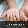 Dry Fingernails – External Influences And Right Care