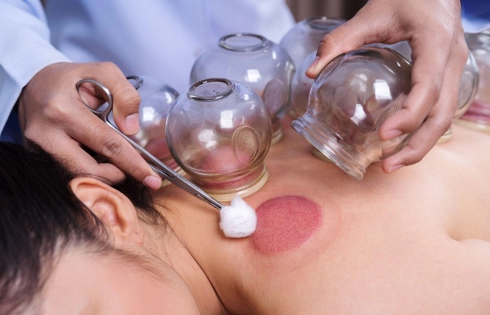 Does Cupping Have Any Advantages?