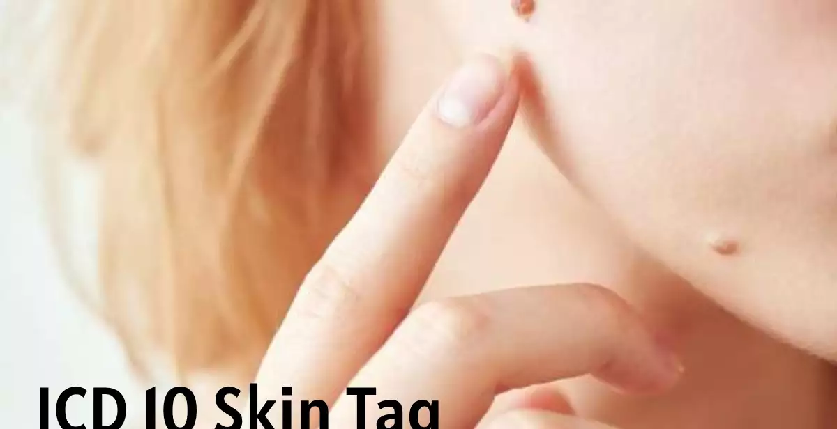 ICD 10 Skin Tag