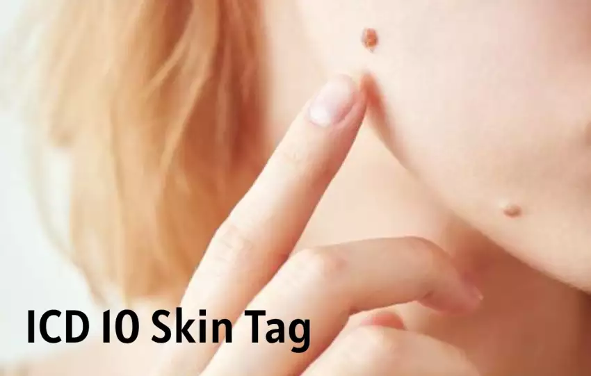 ICD 10 Skin Tag