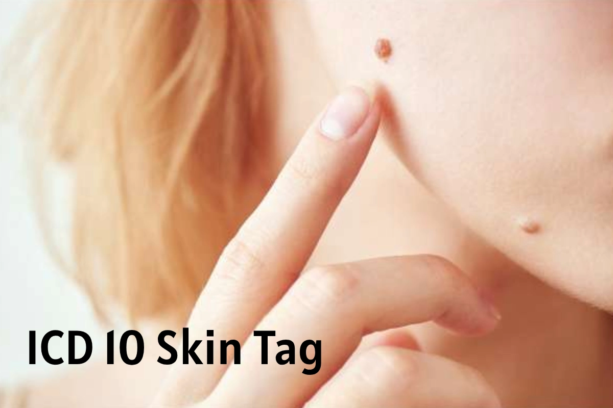 ICD 10 Skin Tag
