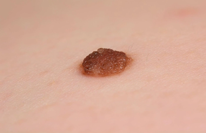 Treatment for ICD 10 Skin Tag
