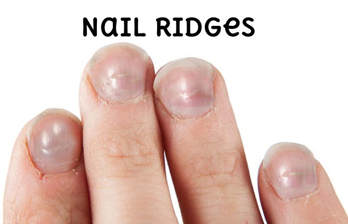Nail Ridges