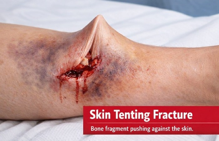 Skin Tenting Fracture